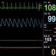 Illustration for article titled Why Shocking a “Flat-Lined” Heart Cant Get It Going Again